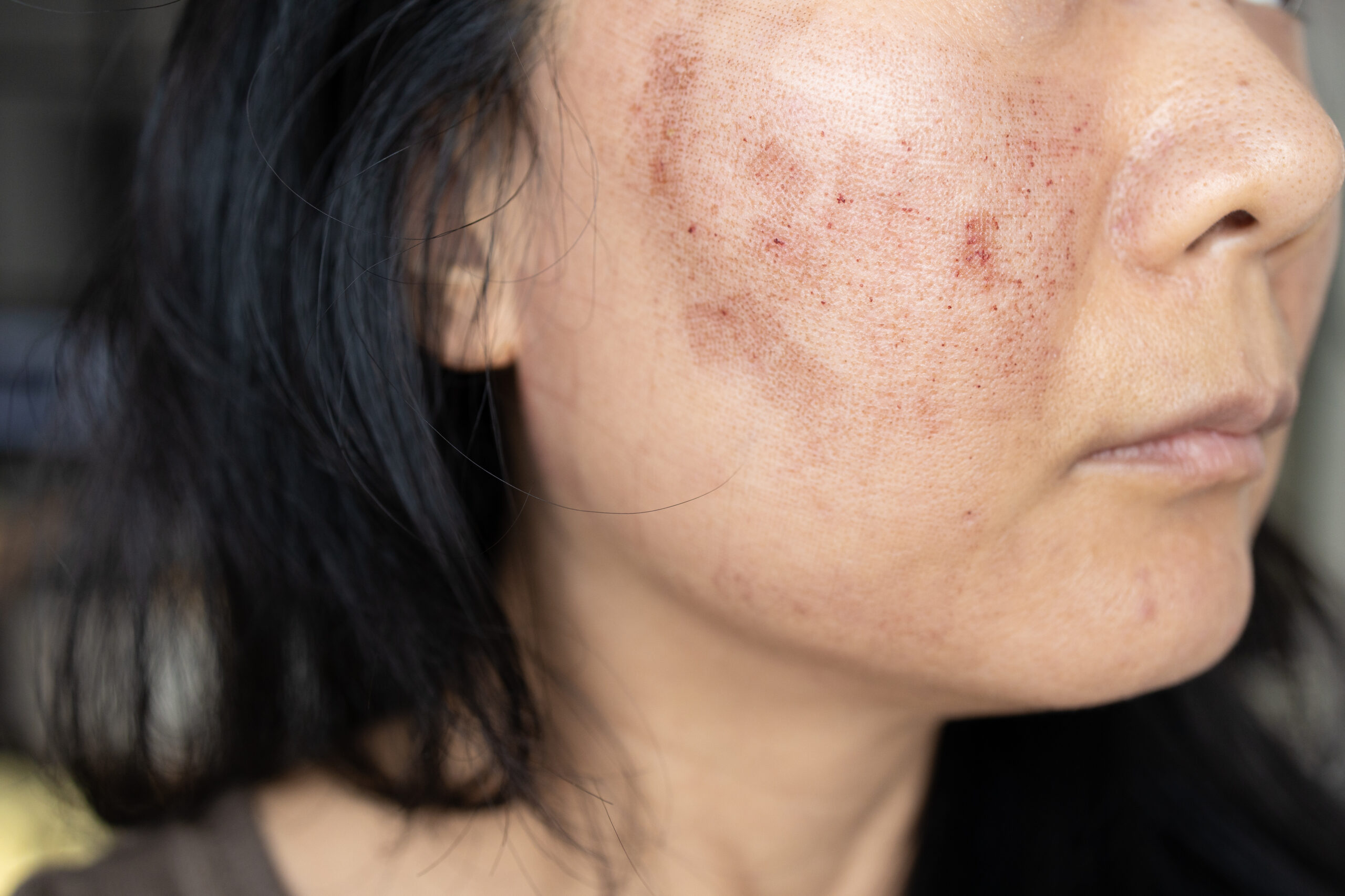 Melasma treatment at Couture Dermatology and Laser Beverly Hills