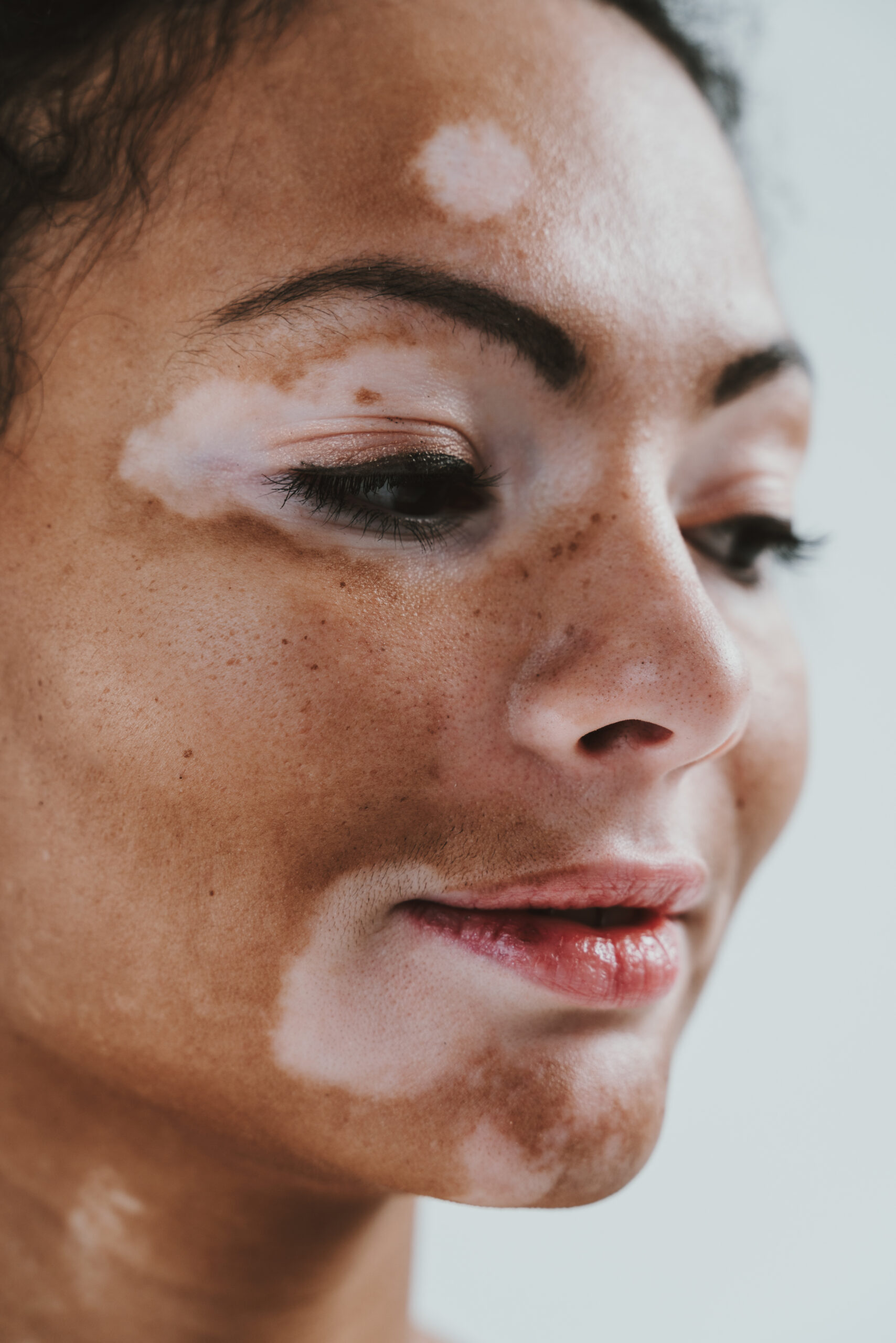 Clinical assessment of hyperpigmentation at Couture Dermatology and Laser Beverly Hills