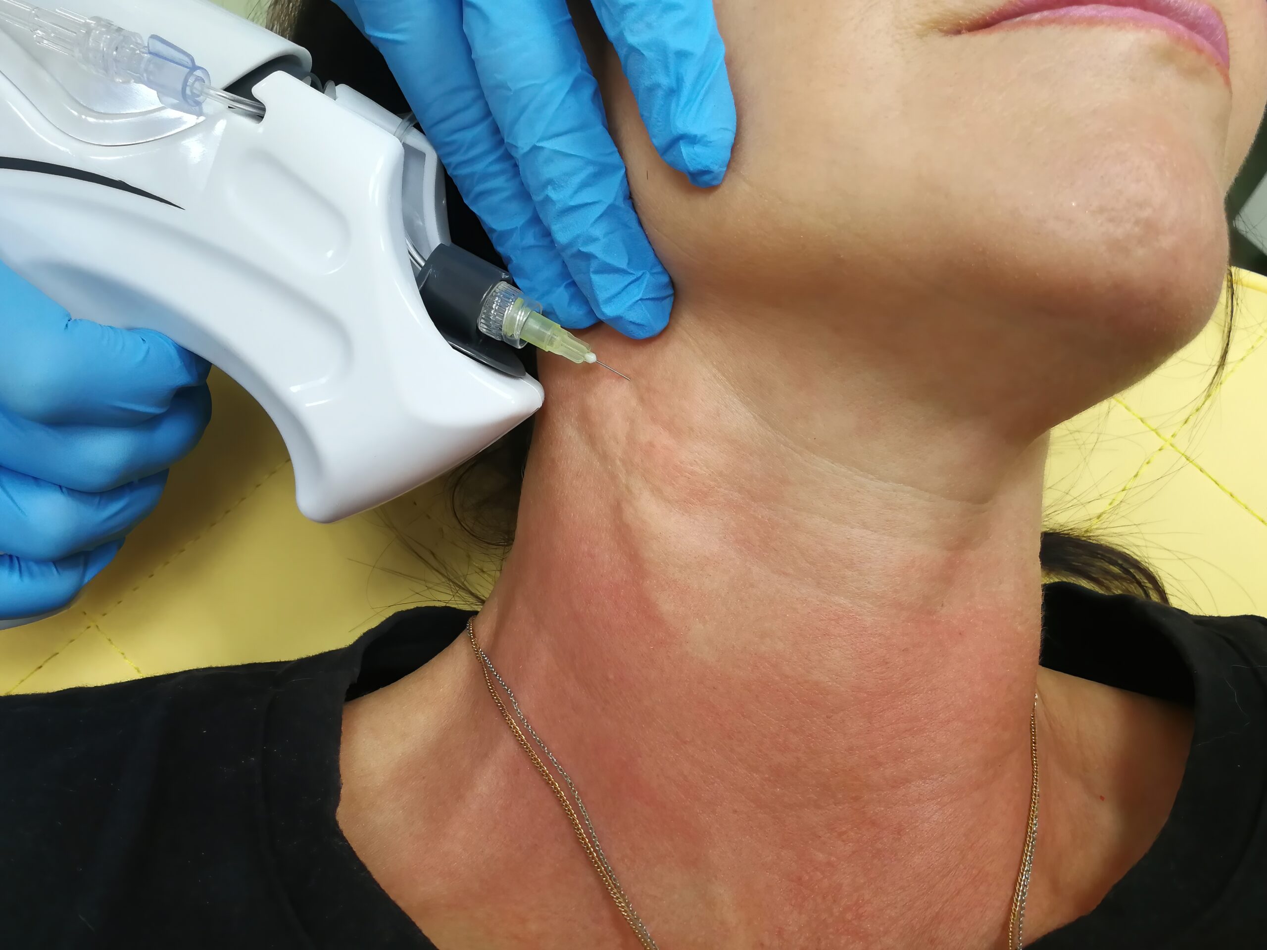 Neck rejuvenation treatment in progress at Couture Dermatology Beverly Hills