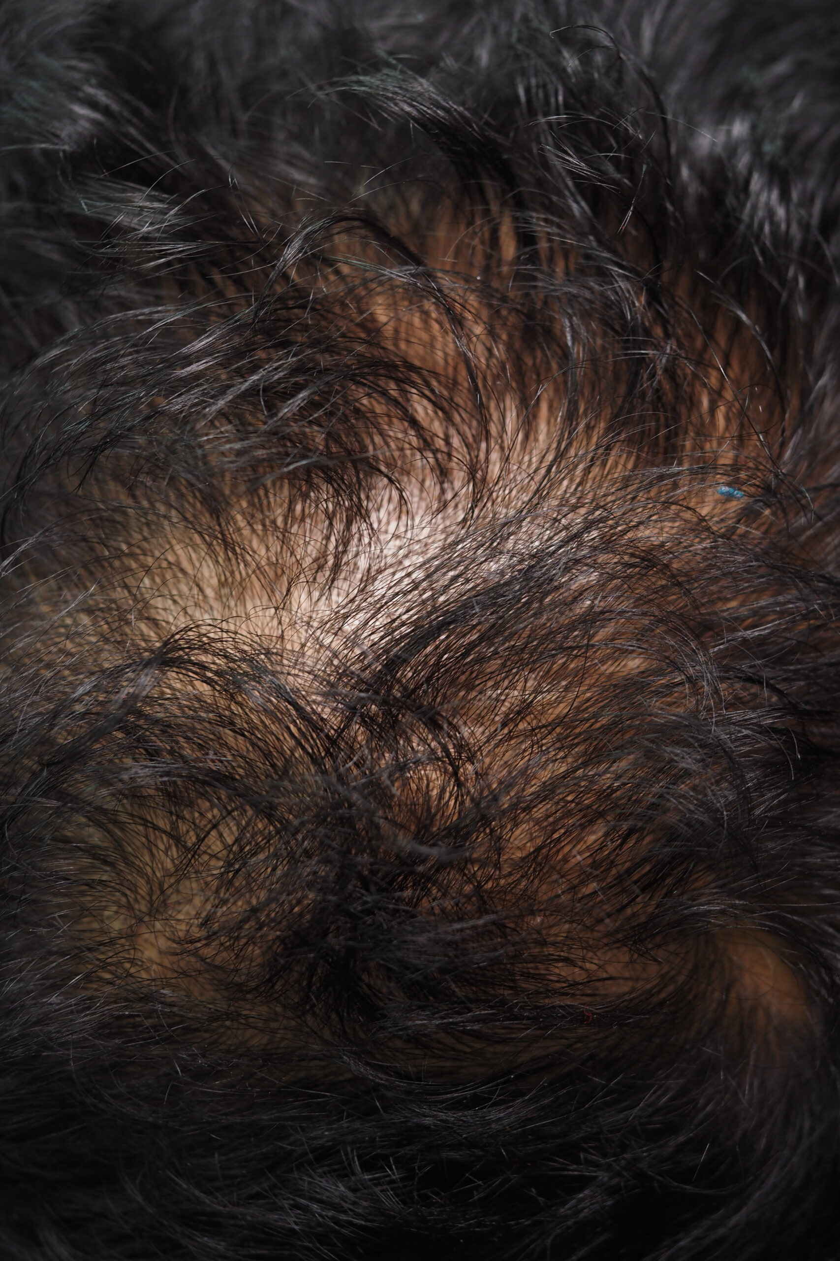 Close-up of scalp showing hair loss pattern at Couture Dermatology and Laser Beverly Hills