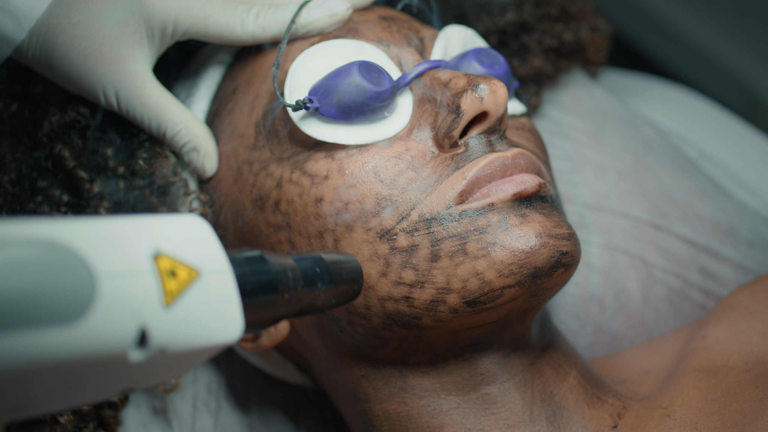 Close-up of fractional laser resurfacing procedure at Couture Dermatology and Laser Beverly Hills