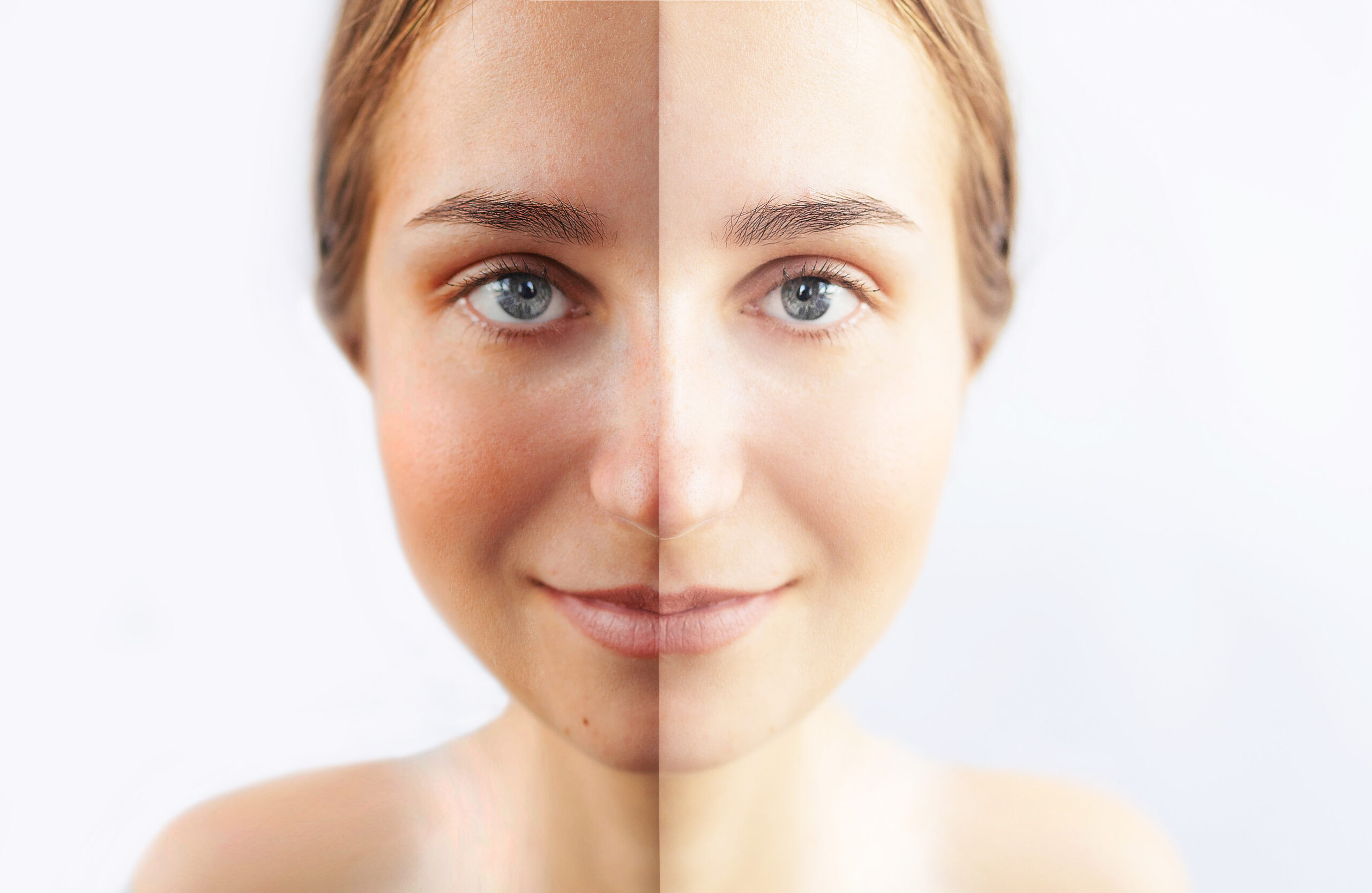 Melasma correction treatment at Couture Dermatology Beverly Hills — before and after skin comparison