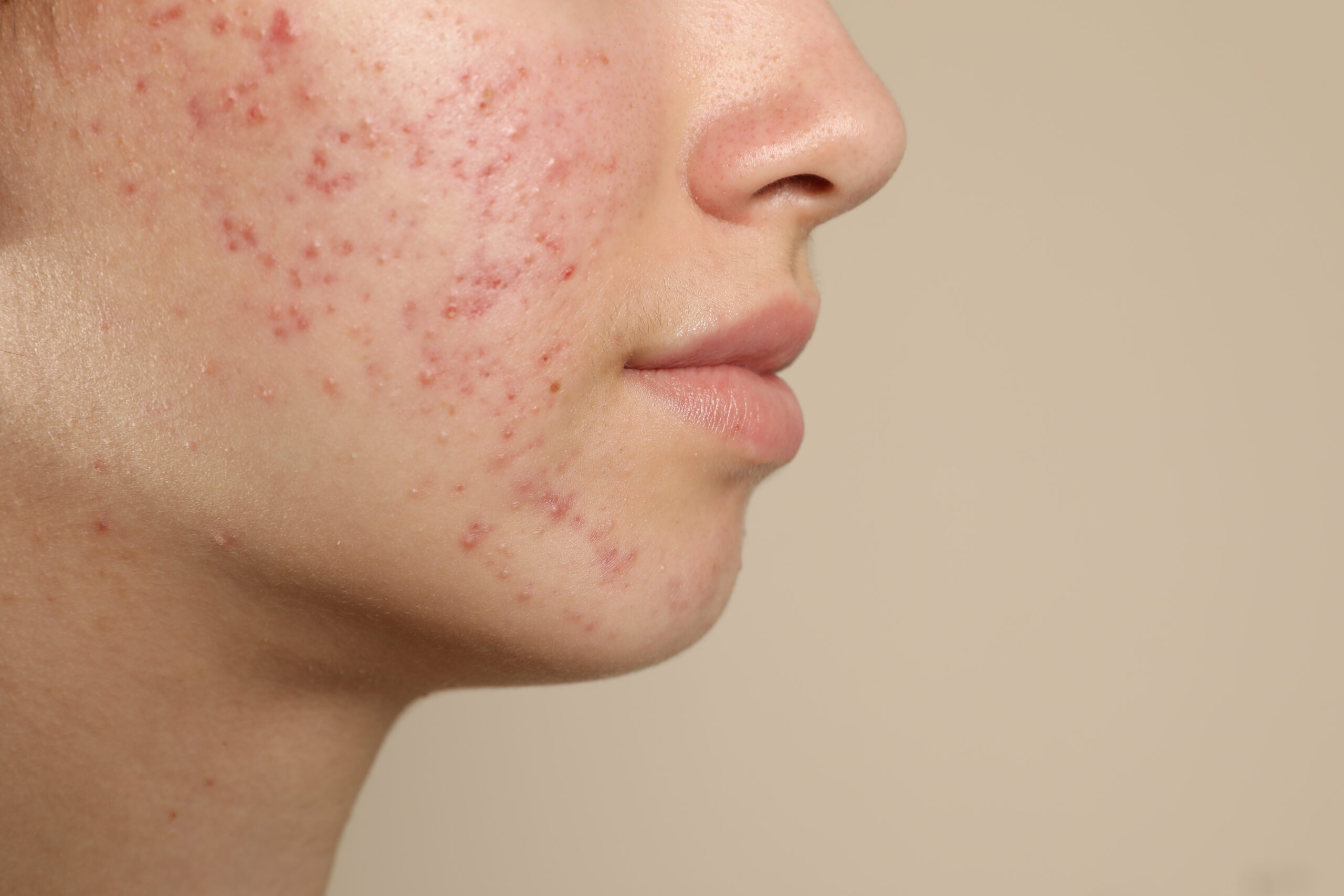 Acne scar texture types and morphology assessment at Couture Dermatology and Laser