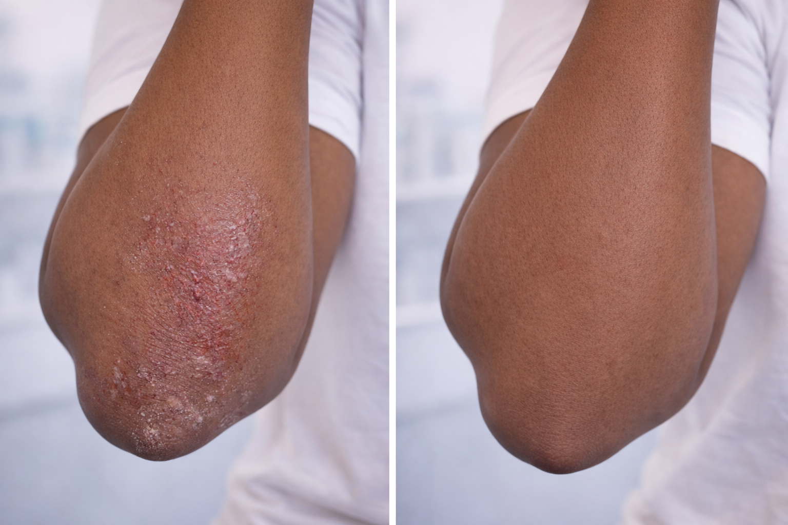 Eczema Treatment before and after results at Couture Dermatology and Laser Beverly Hills