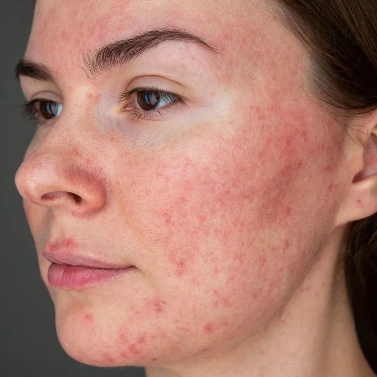 Close-up showing rosacea skin condition at Couture Dermatology and Laser