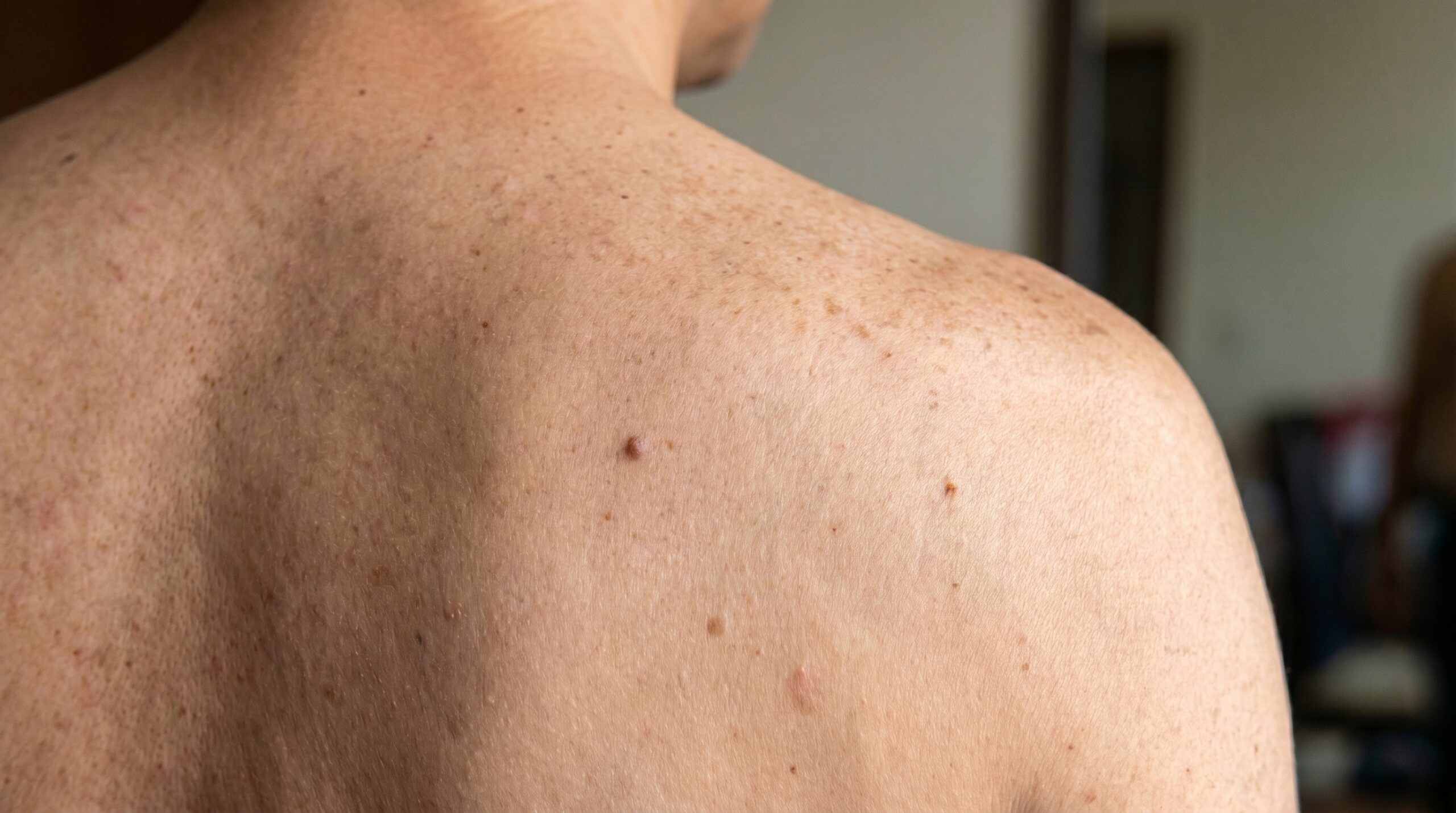 Dermoscopy assessment of melanocytic nevi at Couture Dermatology and Laser Beverly Hills