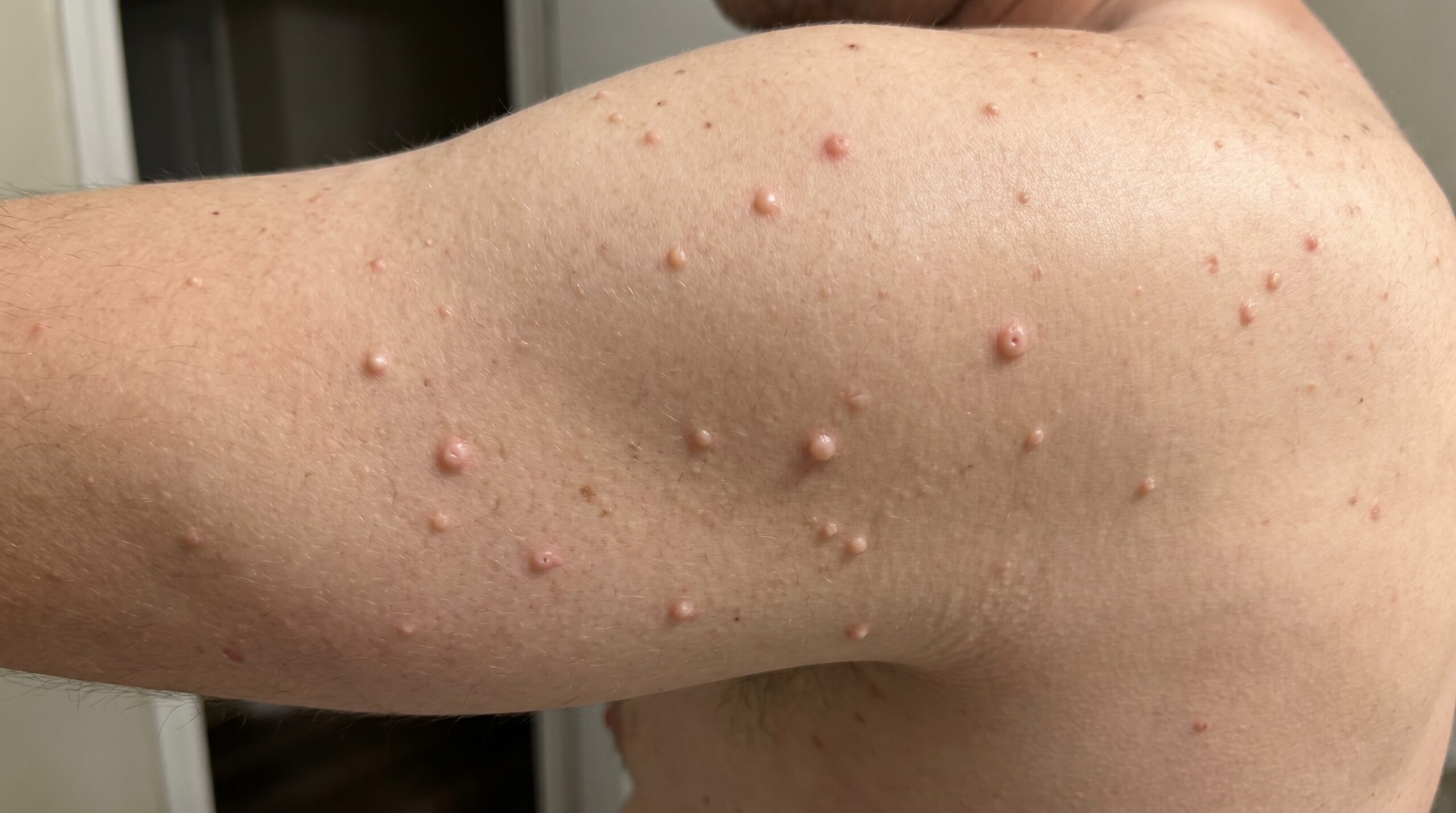 Close view of molluscum contagiosum dome-shaped papules with umbilication, as seen in clinical dermatology