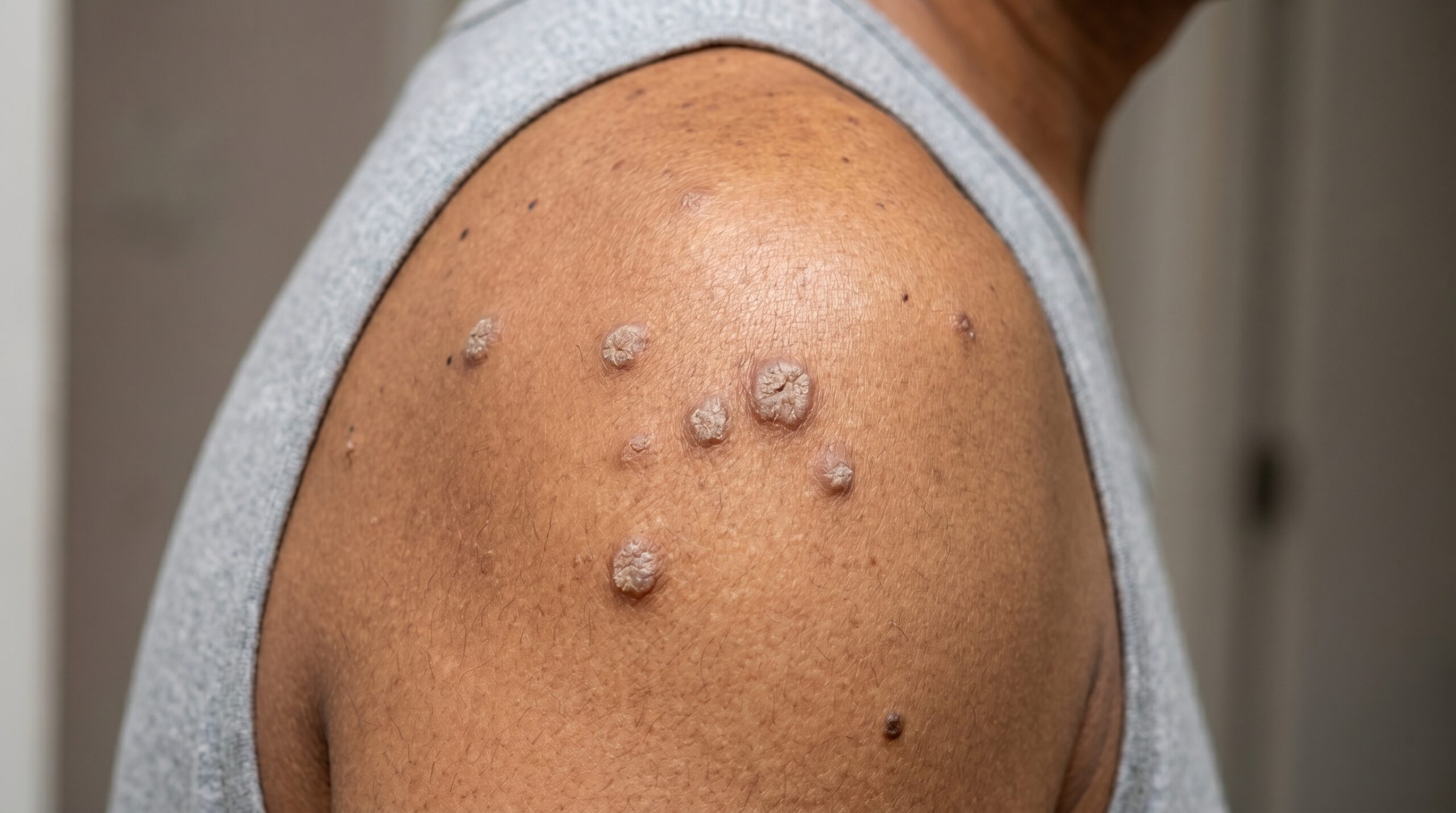 Close-up clinical view of wart types — plantar, common, and periungual — at Couture Dermatology and Laser