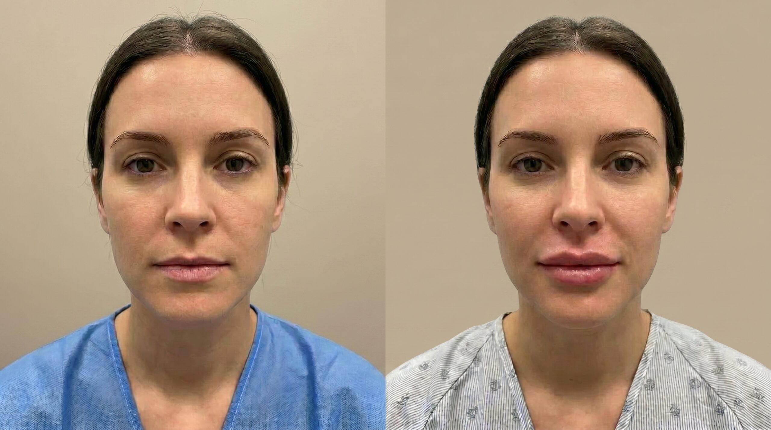 Lip Enhancement before and after results at Couture Dermatology and Laser Beverly Hills Beverly Hills