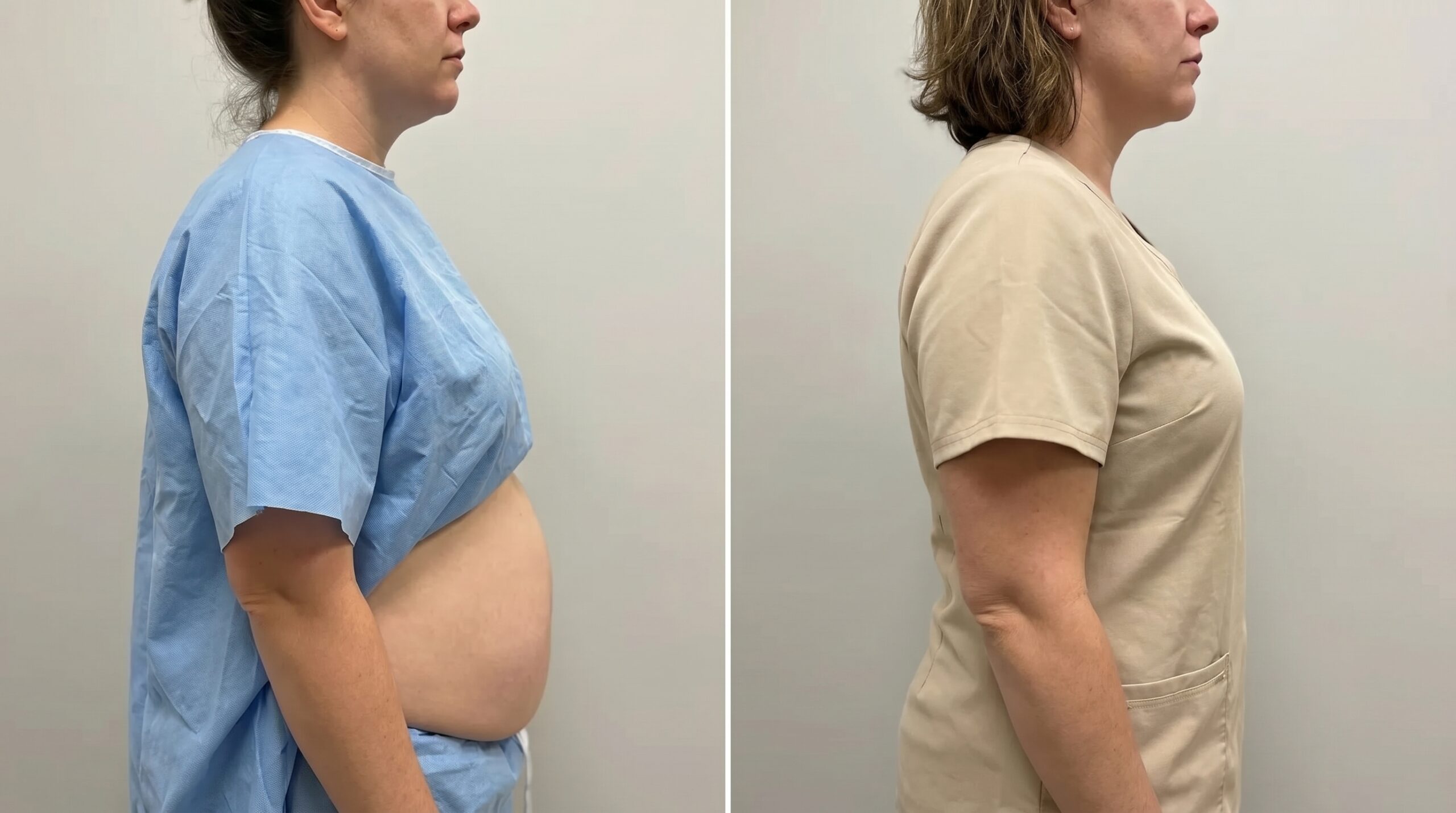 Body Contouring before and after results at Couture Dermatology and Laser Beverly Hills