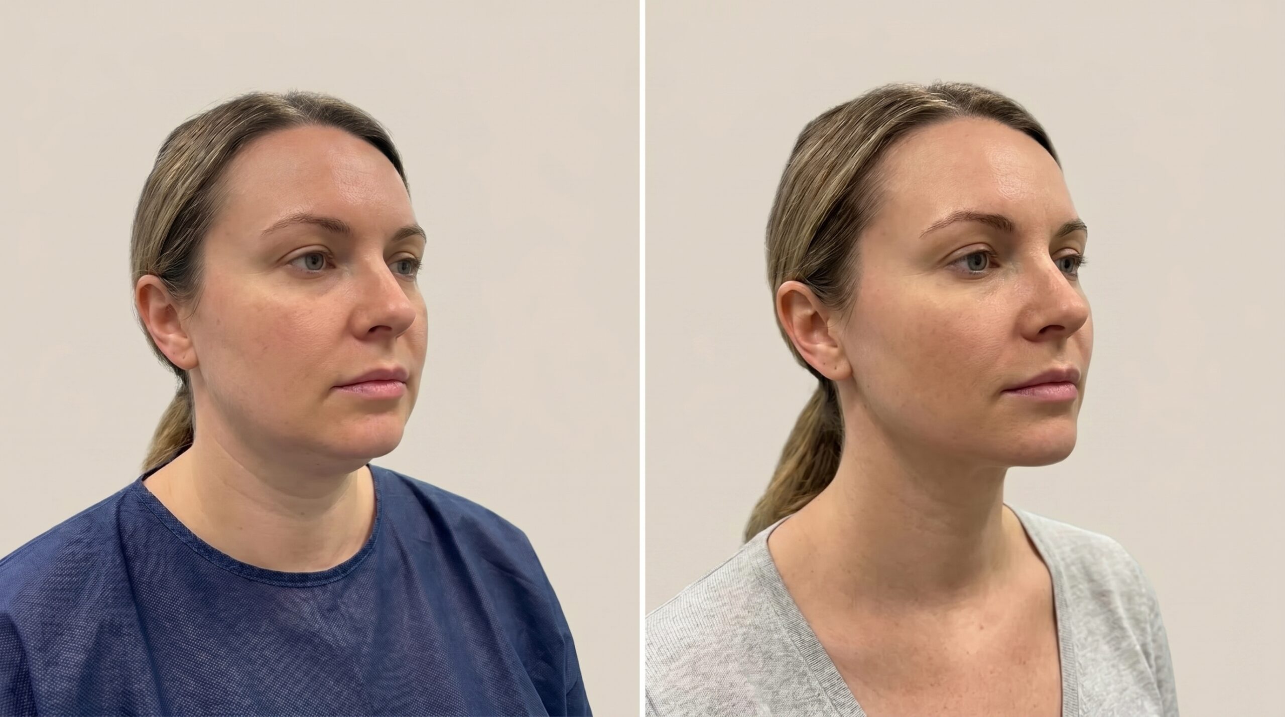 Neck Contouring before and after results at Couture Dermatology and Laser Beverly Hills Beverly Hills