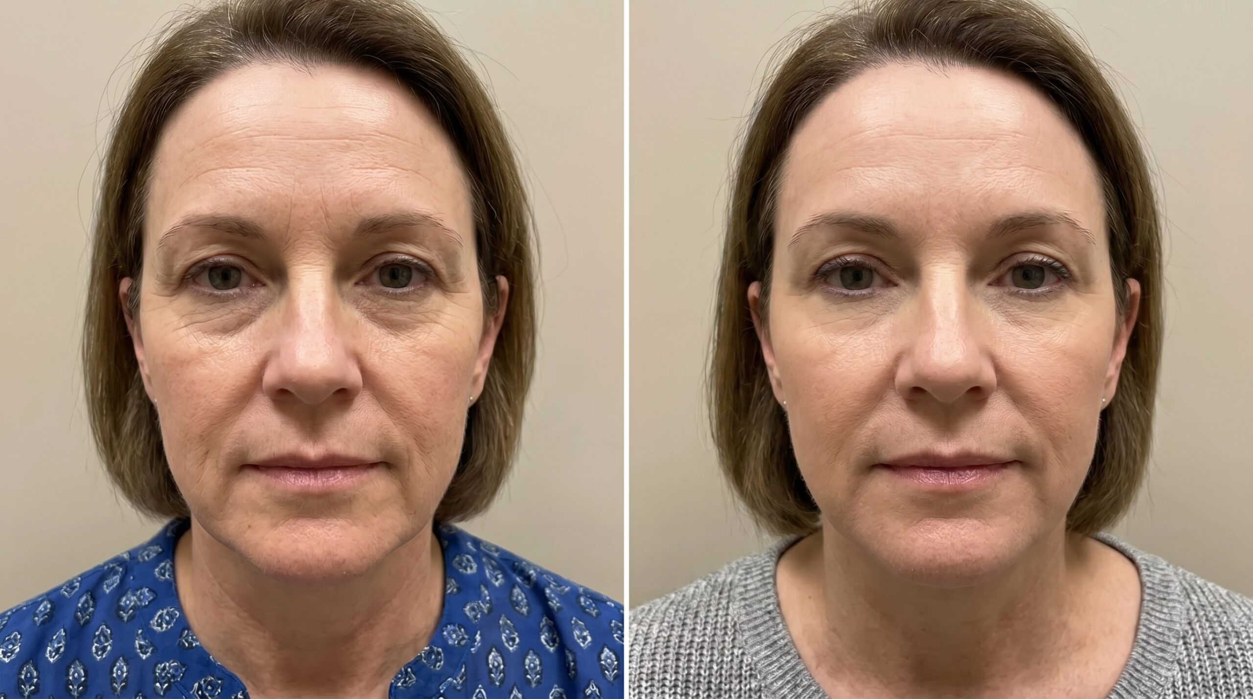 Wrinkle Softening before and after results at Couture Dermatology and Laser Beverly Hills Beverly Hills