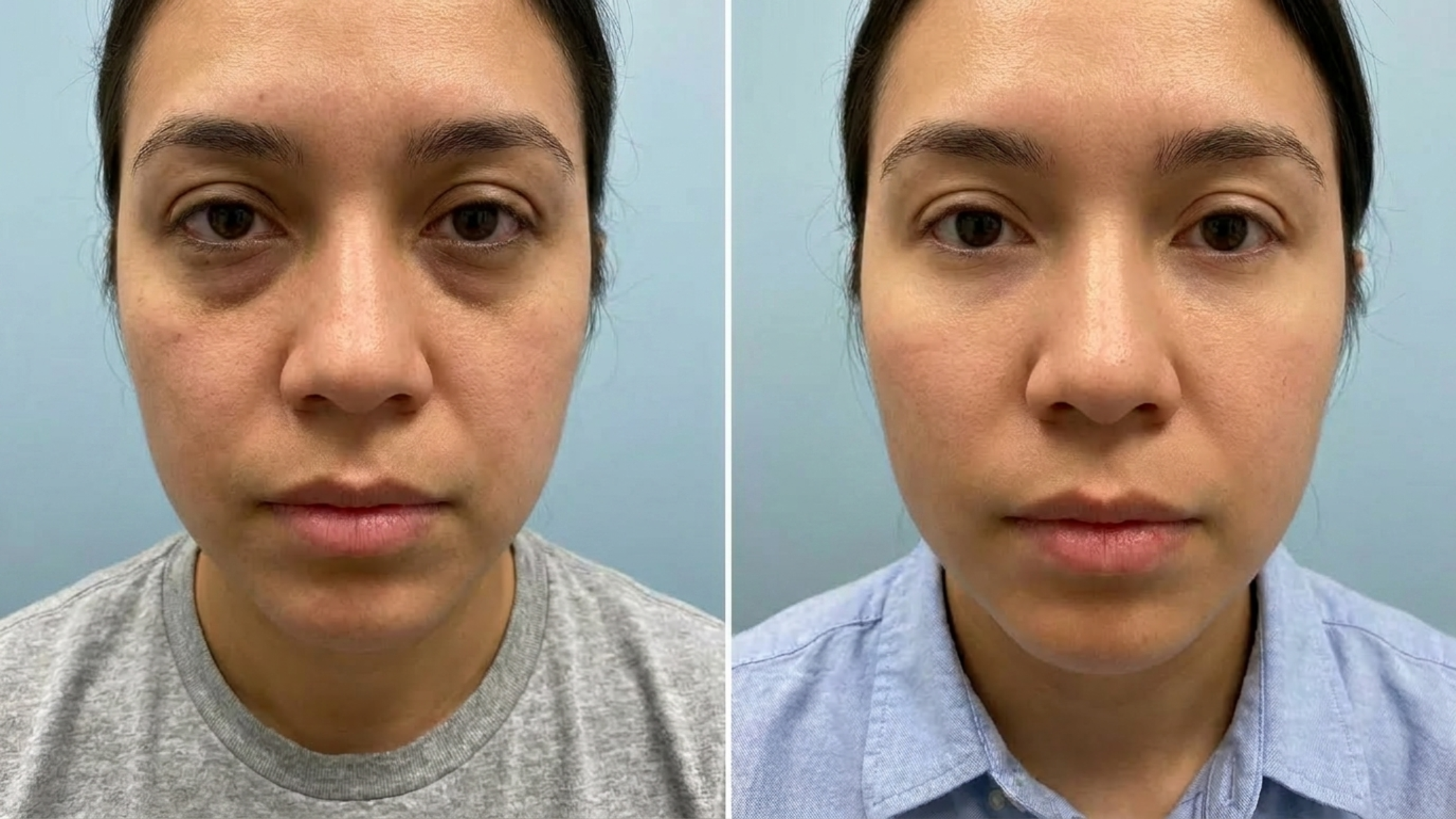 Under-Eye Brightening before and after results at Couture Dermatology and Laser Beverly Hills Beverly Hills